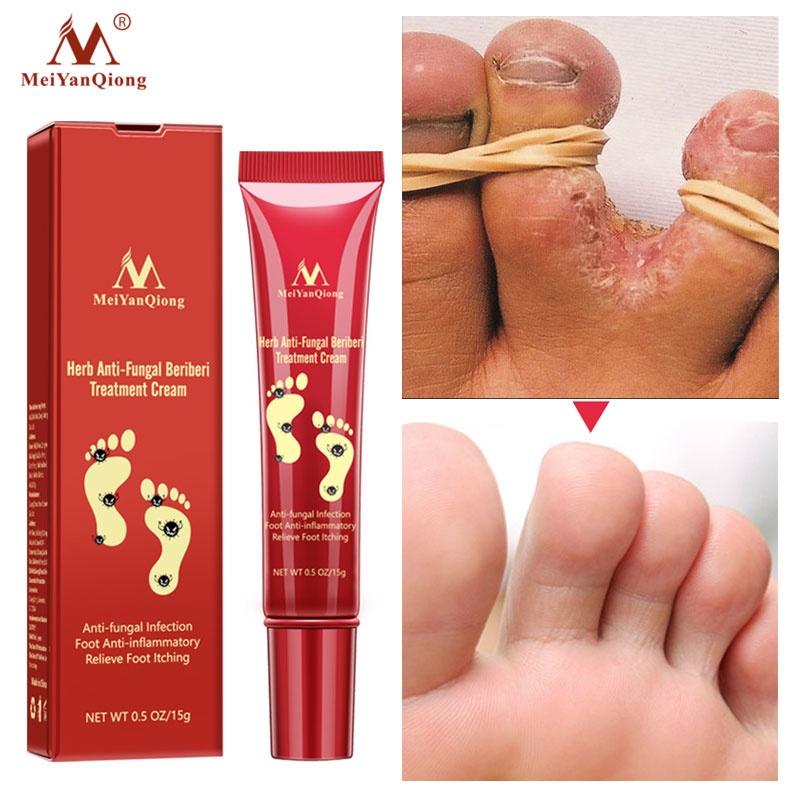shop with crypto buy Herbal Effective Foot Cream Treatment Anti Fungal Infection Onychomycosis Paronychia Toe Fungus Gel Repair Dry Crack Feet Care pay with bitcoin
